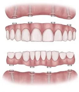 All-on-4-Concept – Advanced Dental Implants